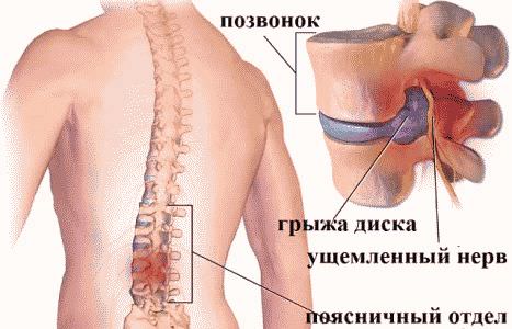 Что делать при боли сбоку в спине