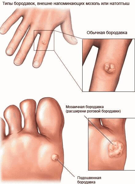 Бородавки, которые похожи на мозоли