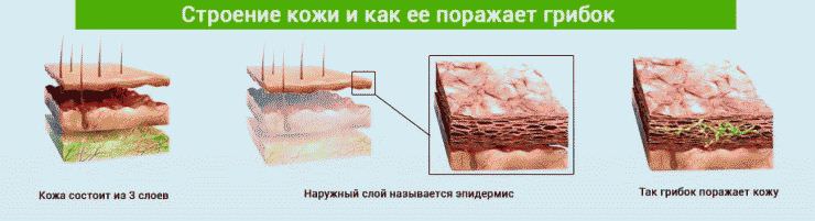 Как грибок поражает кожу
