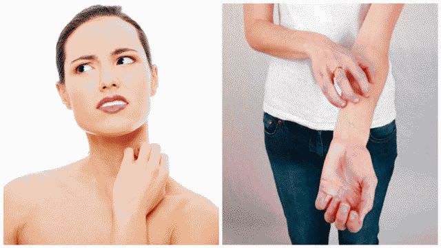 Как лечить лишай в домашних условиях?