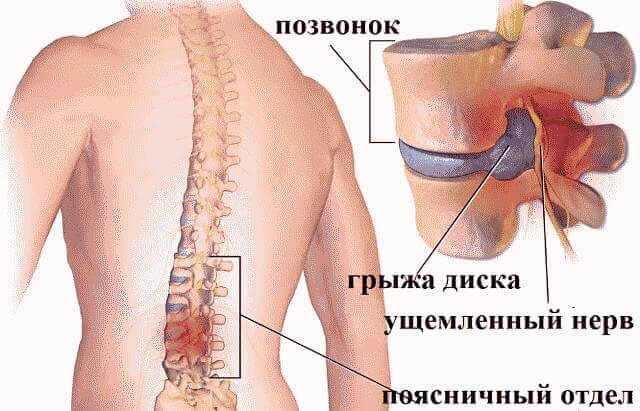 Как вылечить грыжу позвоночника поясничного отдела без операции?