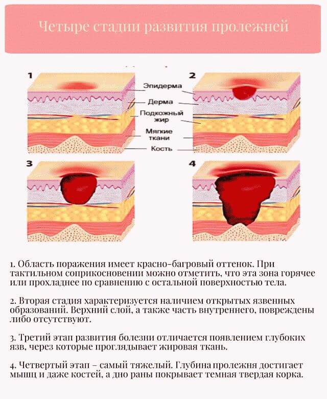 Чем лечить пролежни у лежачих больных в домашних условиях?