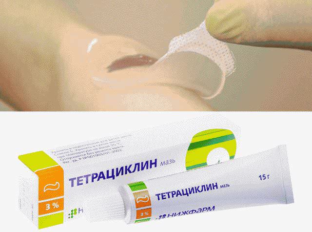 Чем лечить пролежни у лежачих больных в домашних условиях?