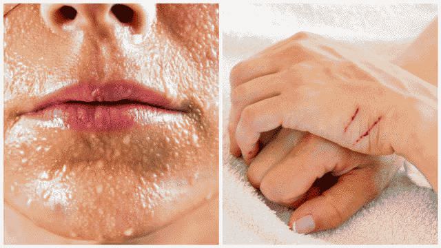 Как лечить фурункул в домашних условиях быстро?