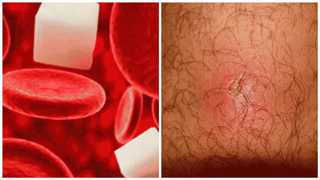 Как лечить фурункул в домашних условиях быстро?