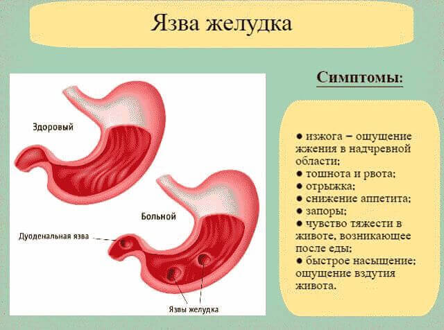 Боль в левом подреберье: что это может быть?